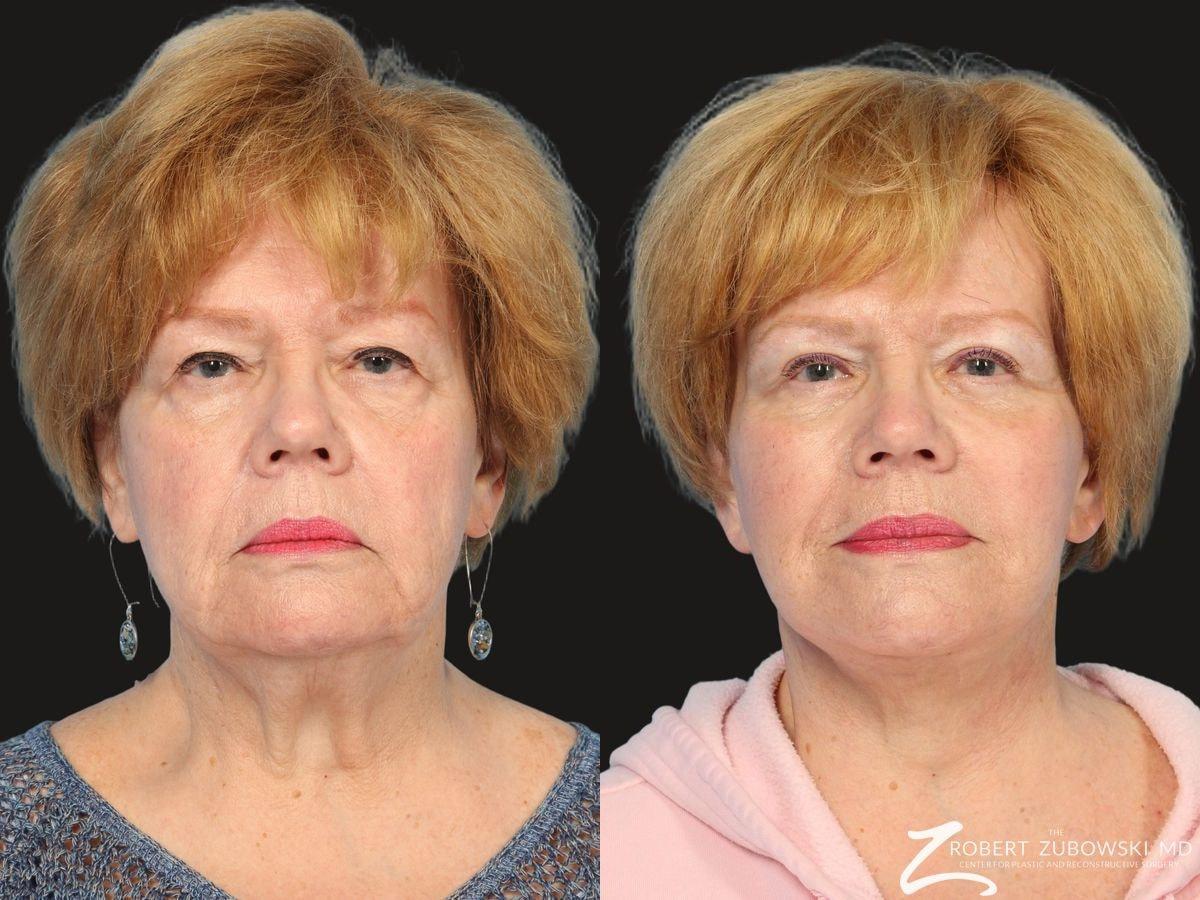 The Robert Zubowski Center facelift result — Paramus, NJ