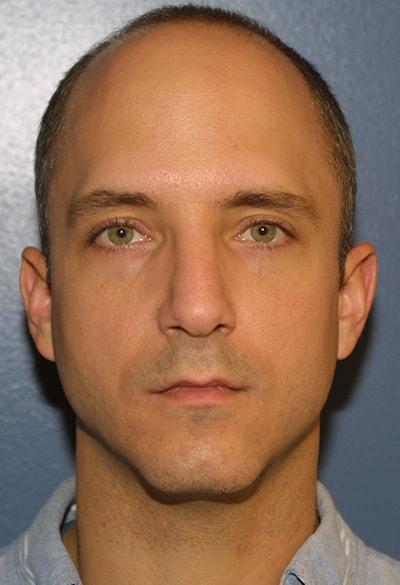 Adam Tattelbaum, MD rhinoplasty after — Rockville, MD
