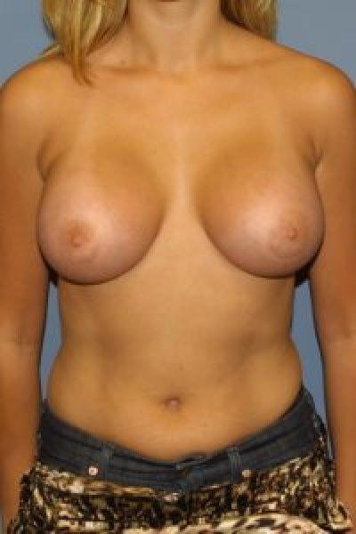 Adam Tattelbaum, MD breast augmentation after — Rockville, MD