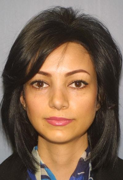 Adam Tattelbaum, MD rhinoplasty after — Rockville, MD