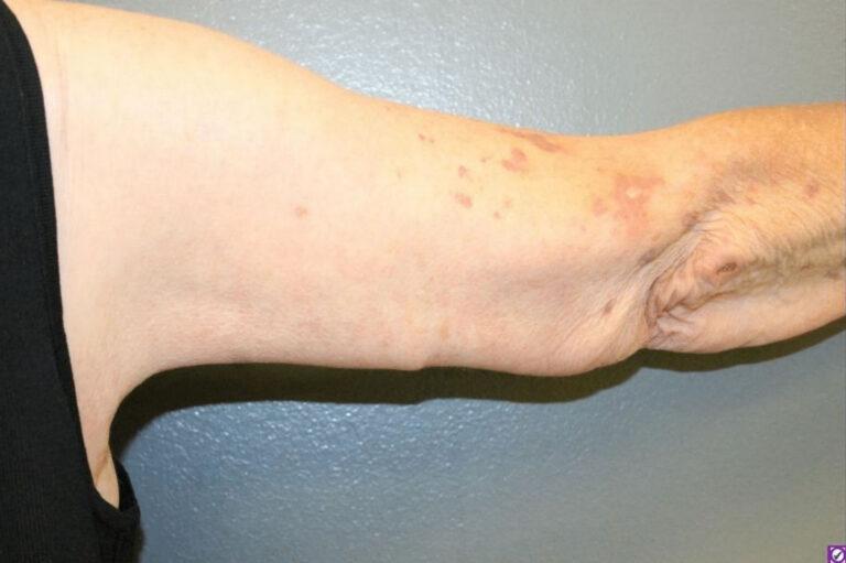DeLozier Plastic Surgery arm lift after — Nashville, TN