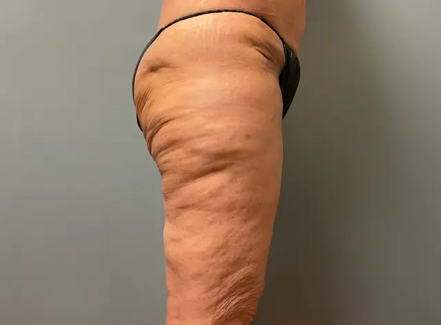 Thigh Lift after at DeLozier Plastic Surgery in Nashville, TN