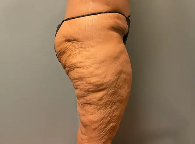 Thigh Lift before at DeLozier Plastic Surgery in Nashville, TN