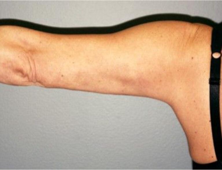 DeLozier Plastic Surgery arm lift after — Nashville, TN