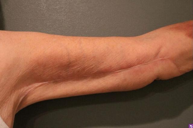 Thigh Lift after at DeLozier Plastic Surgery in Nashville, TN