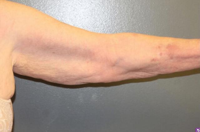 Thigh Lift before at DeLozier Plastic Surgery in Nashville, TN