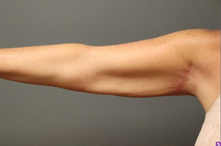 DeLozier Plastic Surgery arm lift after — Nashville, TN