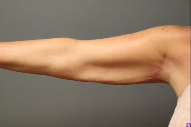 Thigh Lift after at DeLozier Plastic Surgery in Nashville, TN