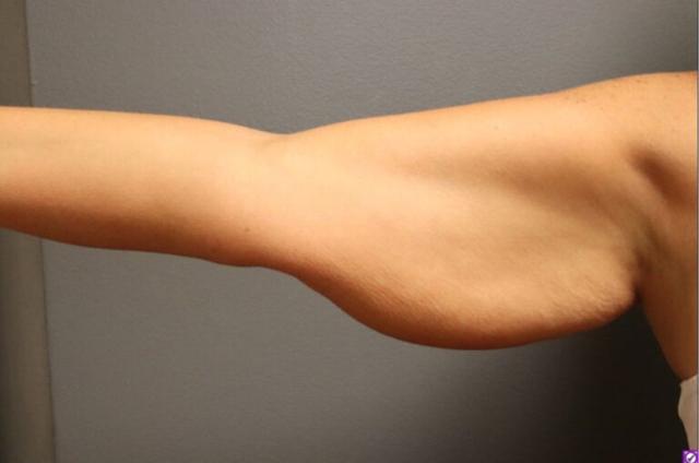 Thigh Lift before at DeLozier Plastic Surgery in Nashville, TN