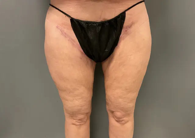 Thigh Lift after at DeLozier Plastic Surgery in Nashville, TN