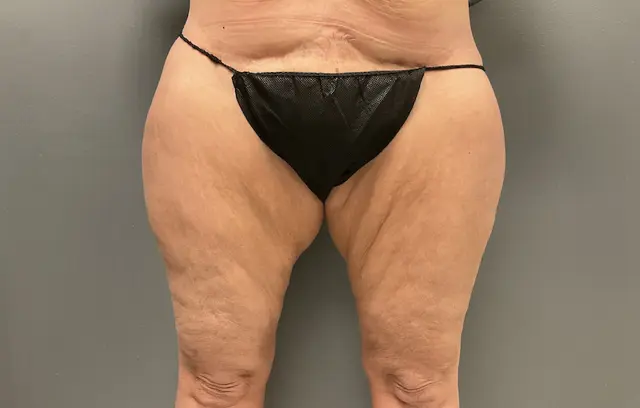 Thigh Lift before at DeLozier Plastic Surgery in Nashville, TN
