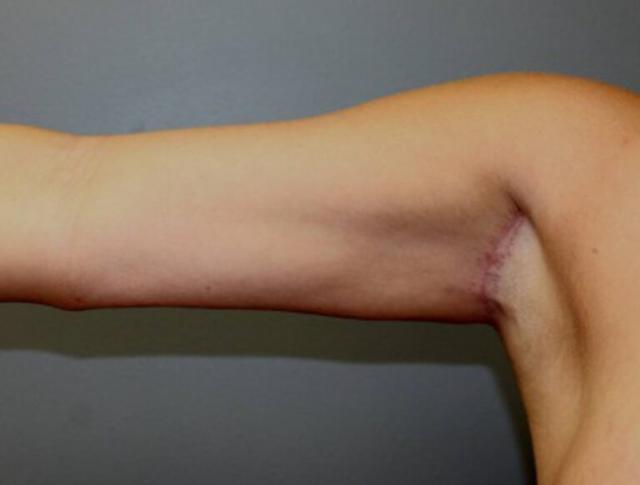 Thigh Lift after at DeLozier Plastic Surgery in Nashville, TN