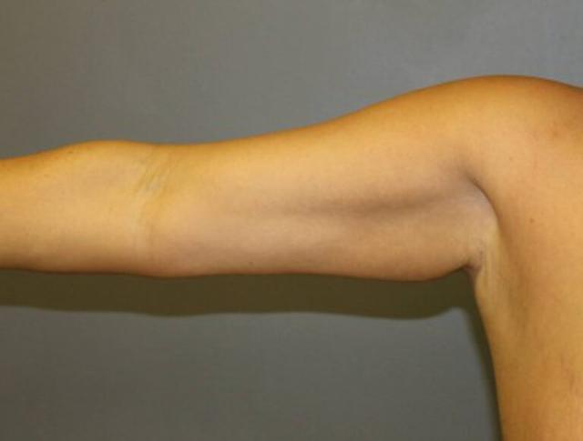 Thigh Lift before at DeLozier Plastic Surgery in Nashville, TN