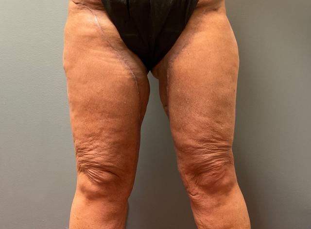 Thigh Lift after at DeLozier Plastic Surgery in Nashville, TN