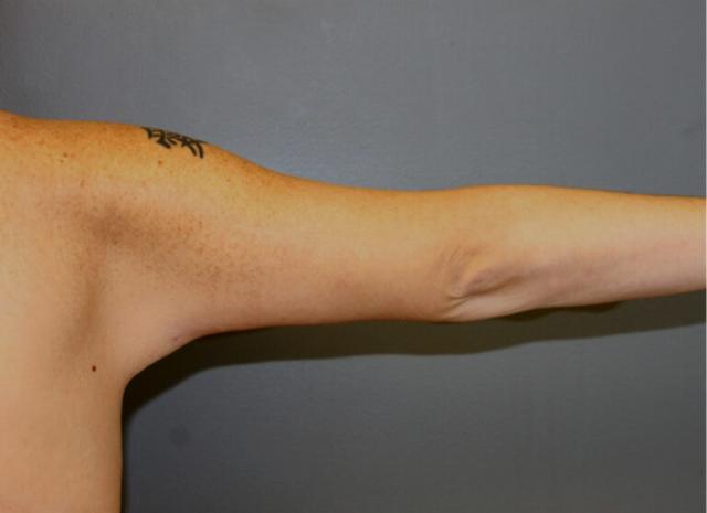 Thigh Lift after at DeLozier Plastic Surgery in Nashville, TN
