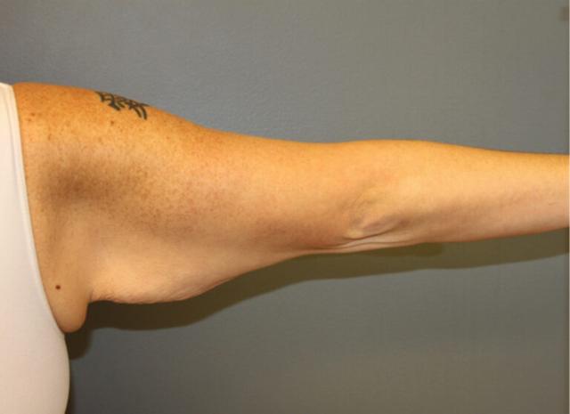 Thigh Lift before at DeLozier Plastic Surgery in Nashville, TN