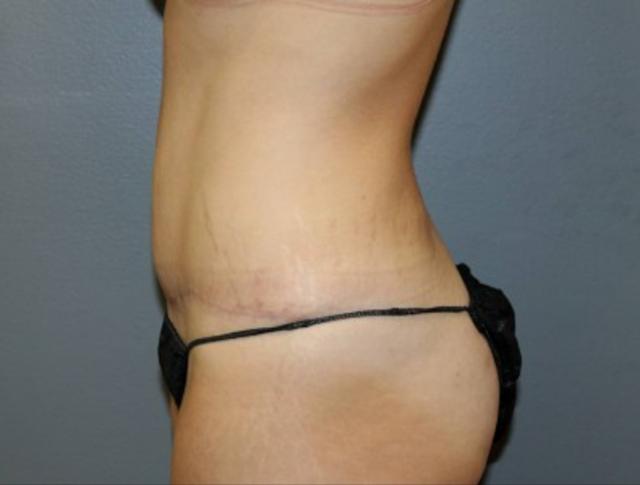 Tummy Tuck after at DeLozier Plastic Surgery in Nashville, TN