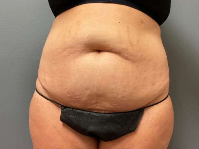 Mini Tummy Tuck before at DeLozier Plastic Surgery in Nashville, TN