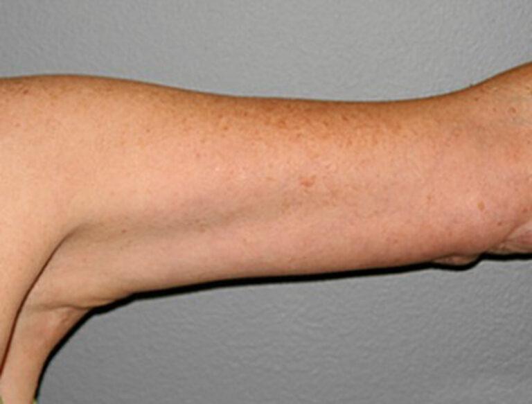 DeLozier Plastic Surgery arm lift after — Nashville, TN