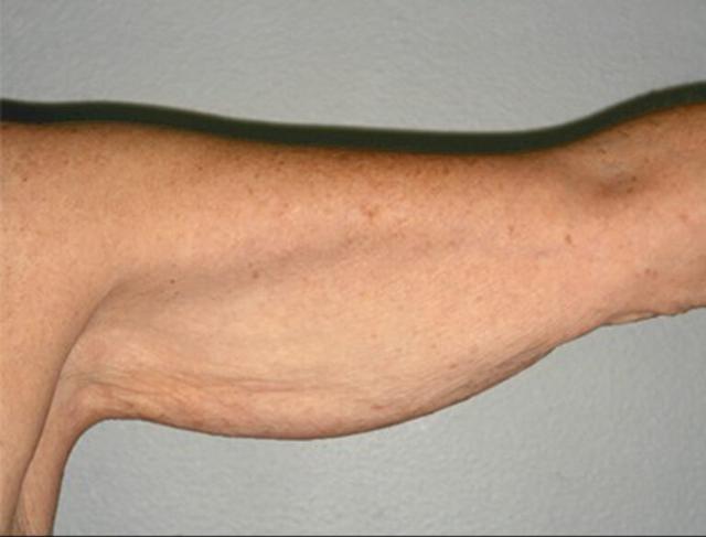 Thigh Lift before at DeLozier Plastic Surgery in Nashville, TN