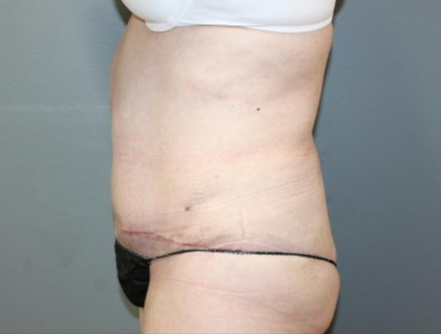 Tummy Tuck after at DeLozier Plastic Surgery in Nashville, TN