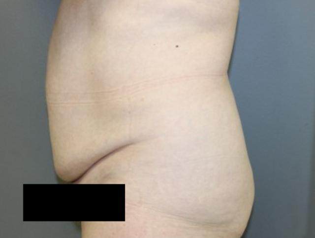 Tummy Tuck before at DeLozier Plastic Surgery in Nashville, TN