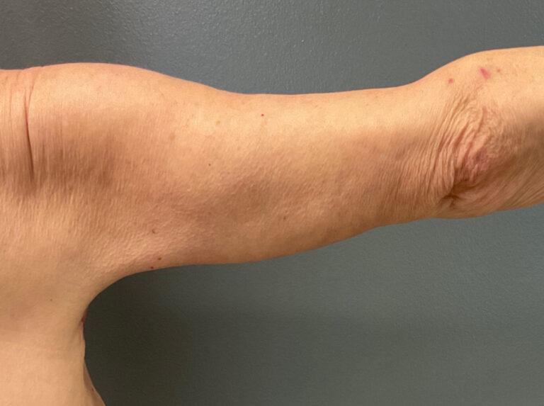 DeLozier Plastic Surgery arm lift after — Nashville, TN