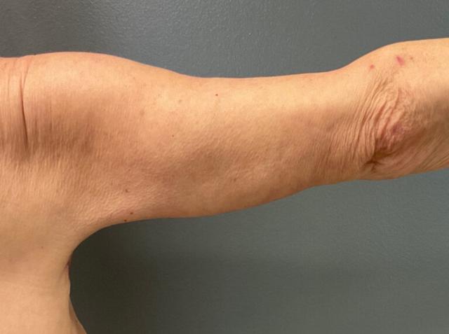 Thigh Lift after at DeLozier Plastic Surgery in Nashville, TN