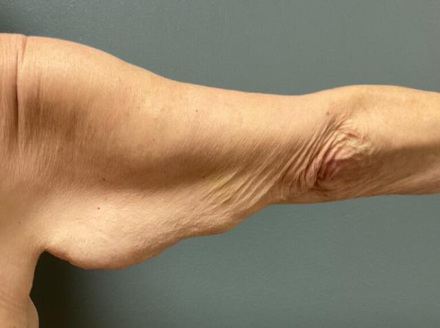 Thigh Lift before at DeLozier Plastic Surgery in Nashville, TN