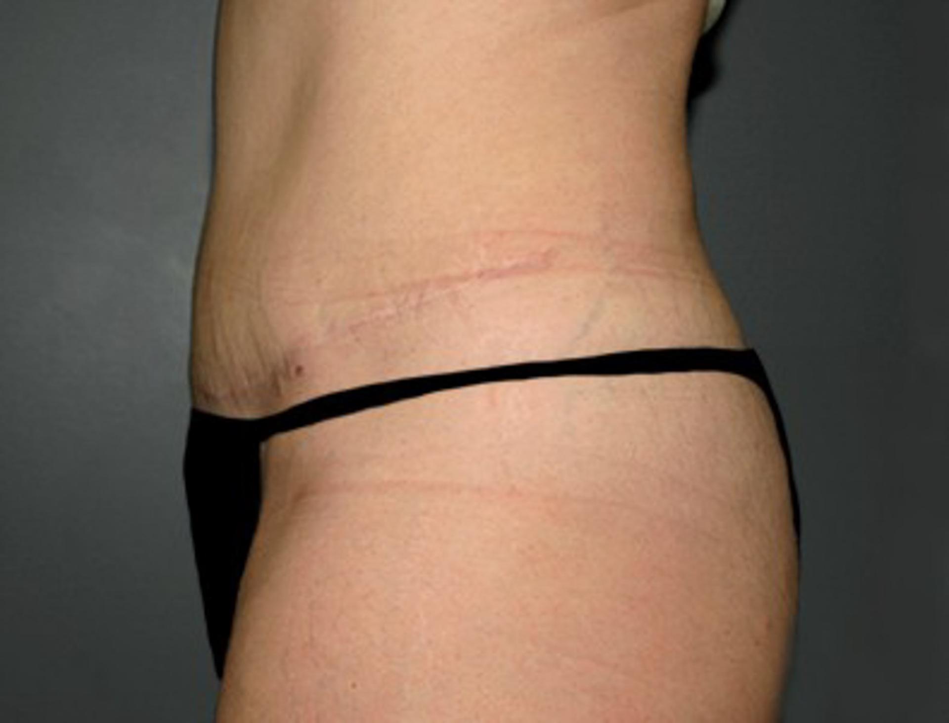 DeLozier Plastic Surgery tummy tuck after — Nashville, TN