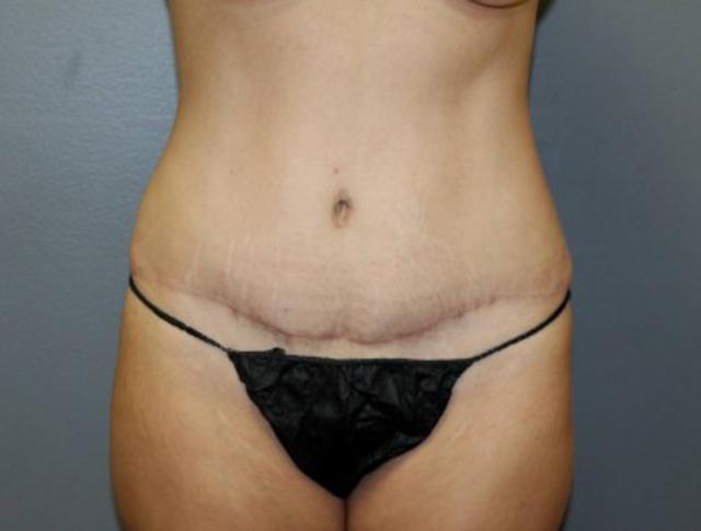Tummy Tuck after at DeLozier Plastic Surgery in Nashville, TN