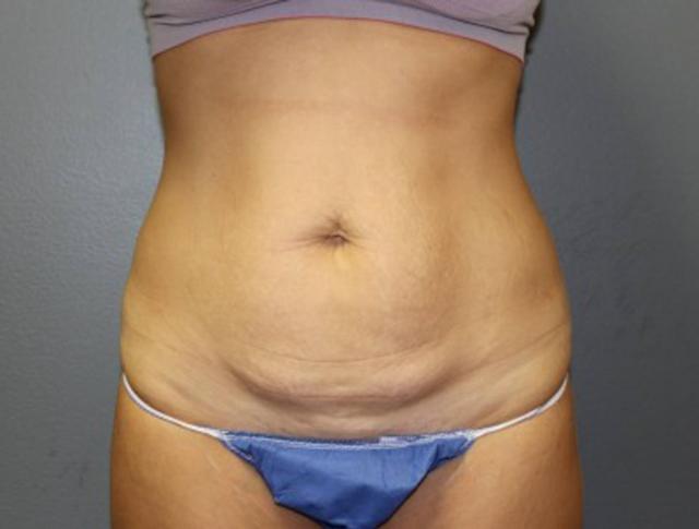 Tummy Tuck before at DeLozier Plastic Surgery in Nashville, TN