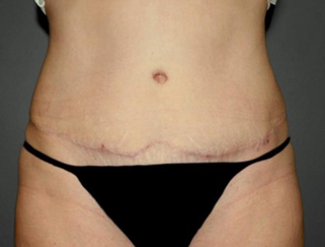 Tummy Tuck after at DeLozier Plastic Surgery in Nashville, TN