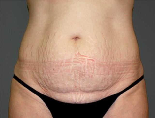 Tummy Tuck before at DeLozier Plastic Surgery in Nashville, TN