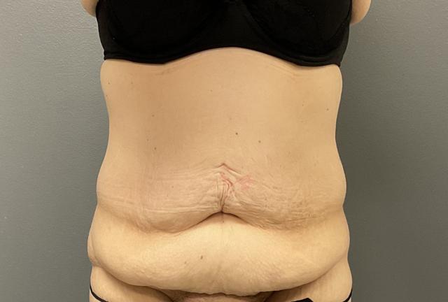 Tummy Tuck before at DeLozier Plastic Surgery in Nashville, TN