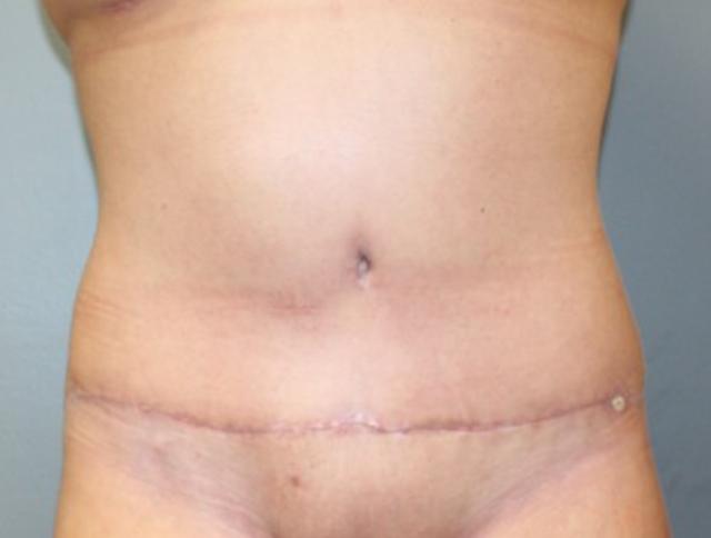 Tummy Tuck after at DeLozier Plastic Surgery in Nashville, TN