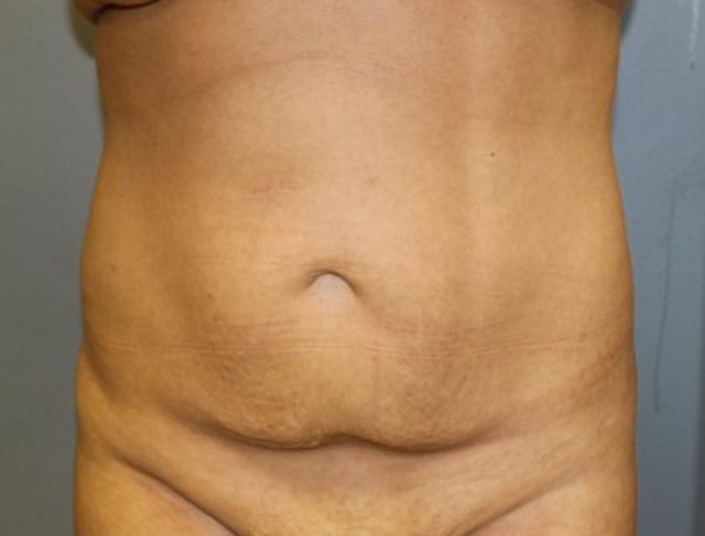 Tummy Tuck before at DeLozier Plastic Surgery in Nashville, TN