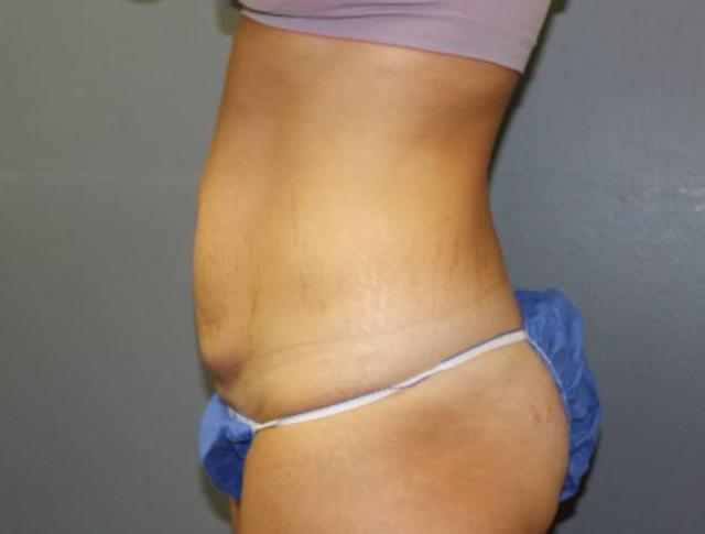 Tummy Tuck before at DeLozier Plastic Surgery in Nashville, TN
