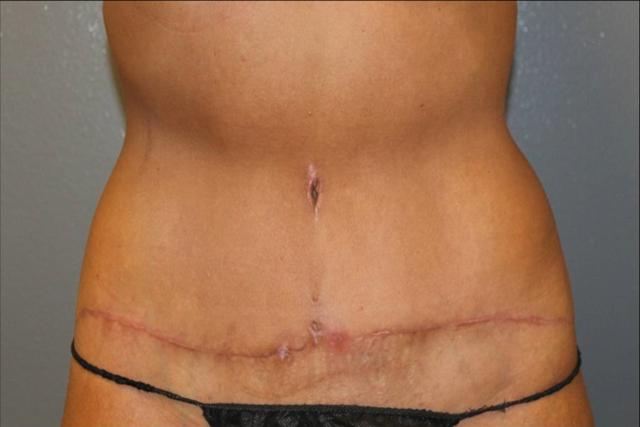 Tummy Tuck after at DeLozier Plastic Surgery in Nashville, TN