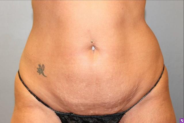Tummy Tuck before at DeLozier Plastic Surgery in Nashville, TN