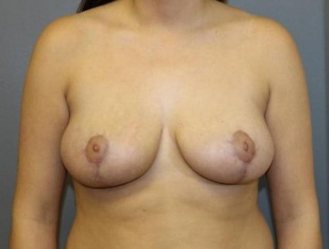 Breast Reduction after at DeLozier Plastic Surgery in Nashville, TN