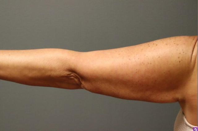Thigh Lift after at DeLozier Plastic Surgery in Nashville, TN