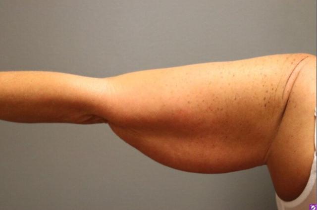 Thigh Lift before at DeLozier Plastic Surgery in Nashville, TN