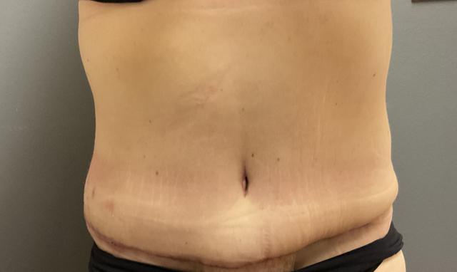 Tummy Tuck after at DeLozier Plastic Surgery in Nashville, TN