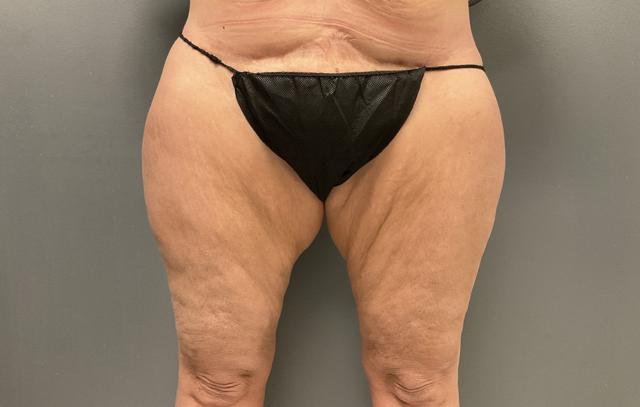 Thigh Lift after at DeLozier Plastic Surgery in Nashville, TN