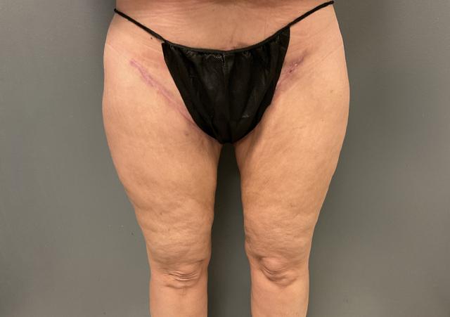 Thigh Lift before at DeLozier Plastic Surgery in Nashville, TN