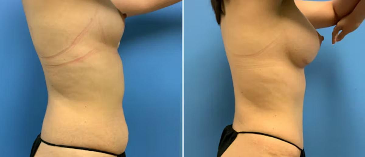CosmetiCare Plastic Surgery Newport Beach & Med Spa mommy makeover result — Newport Beach, CA