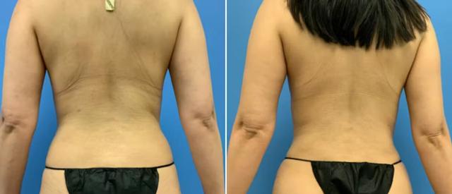 Mommy Makeover result at CosmetiCare Plastic Surgery Newport Beach & Med Spa in Newport Beach, CA