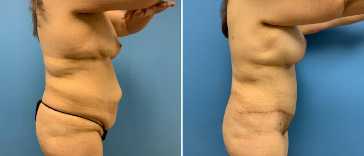 CosmetiCare Plastic Surgery Newport Beach & Med Spa mommy makeover result — Newport Beach, CA