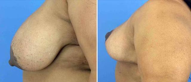 Breast Reduction result at CosmetiCare Plastic Surgery Newport Beach & Med Spa in Newport Beach, CA